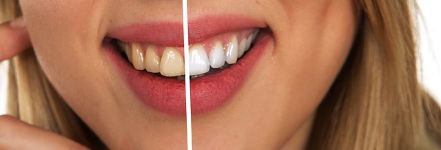 Před a po bělení zubů